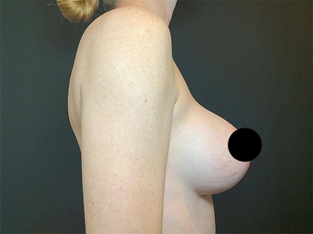 Implant Exchange - Breast Augmentation