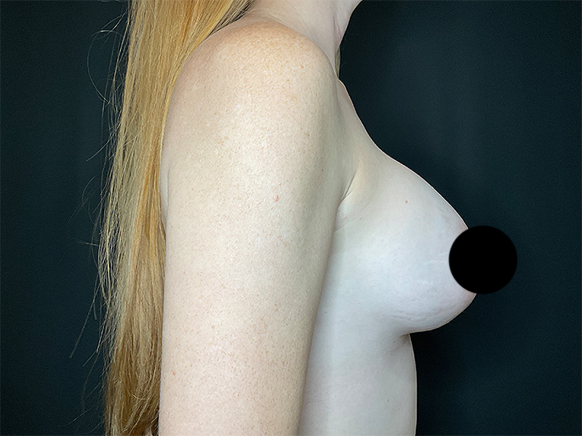 Implant Exchange - Breast Augmentation