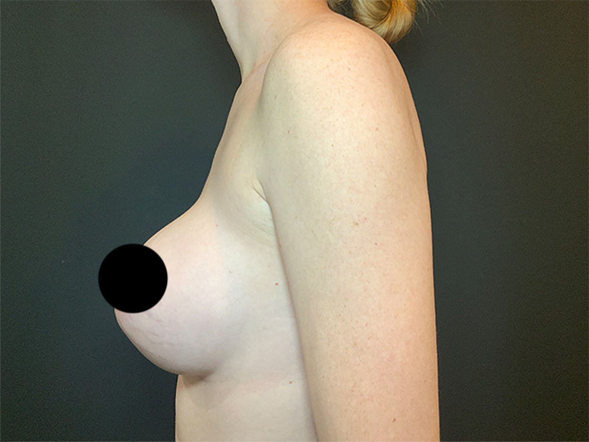 Implant Exchange - Breast Augmentation
