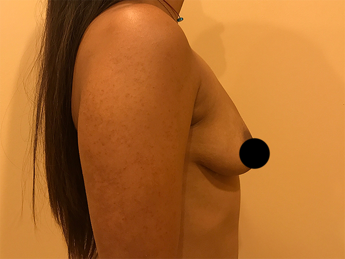 Dual-Plane - Half Under Muscle - Breast Augmentation