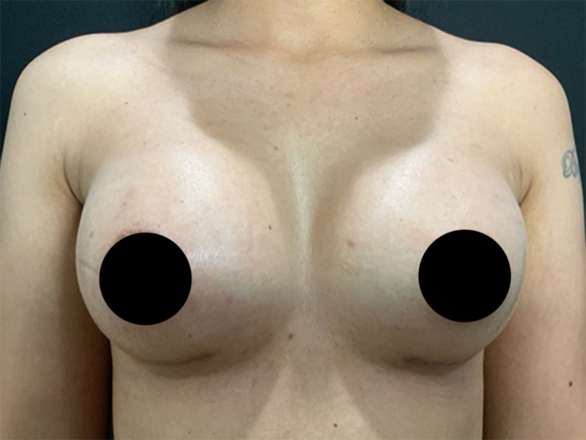Breast Augmentation