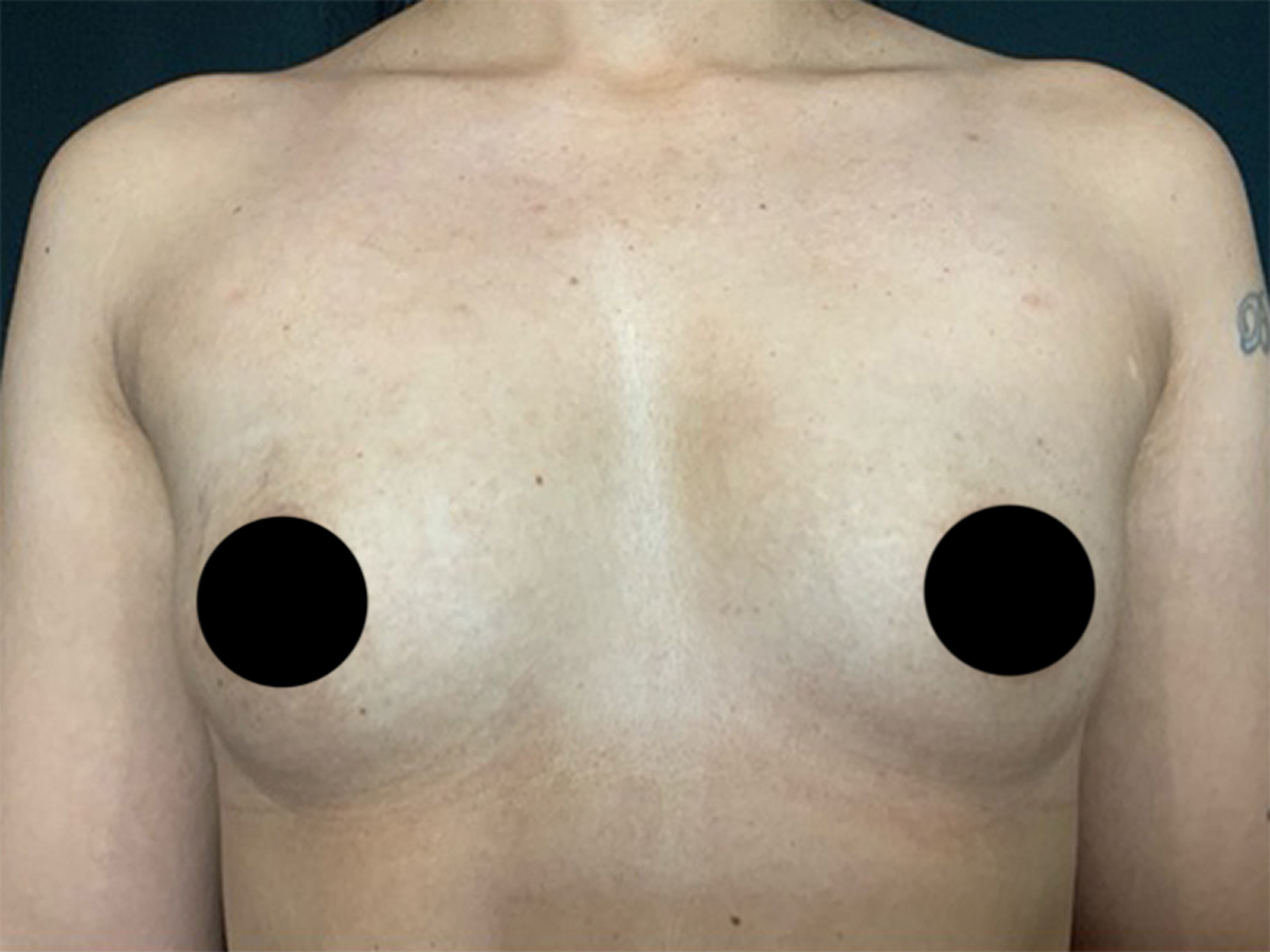Breast Augmentation in Orlando