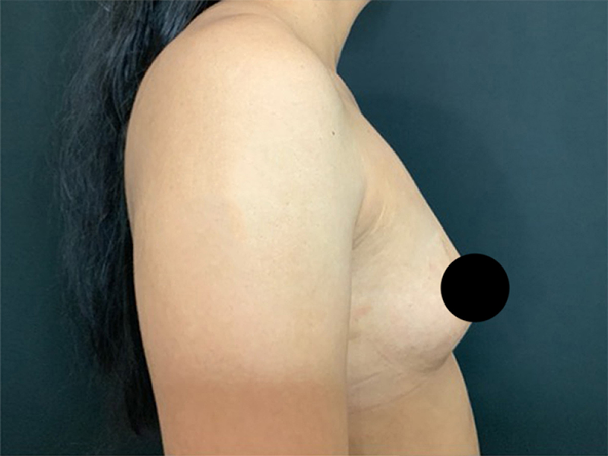 Breast Augmentation