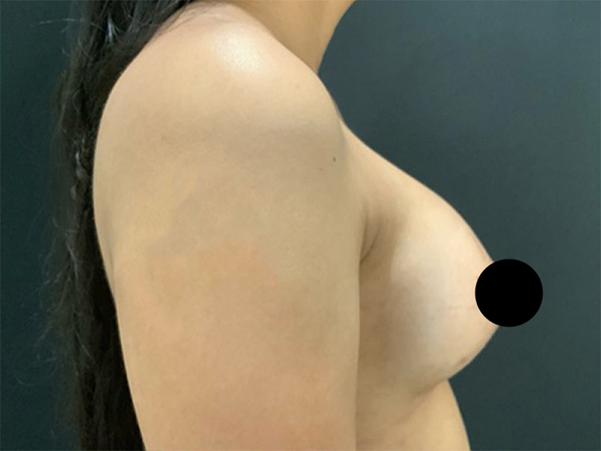 Breast Augmentation