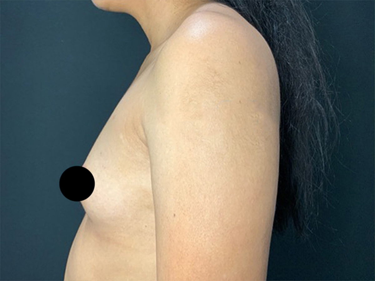 Breast Augmentation