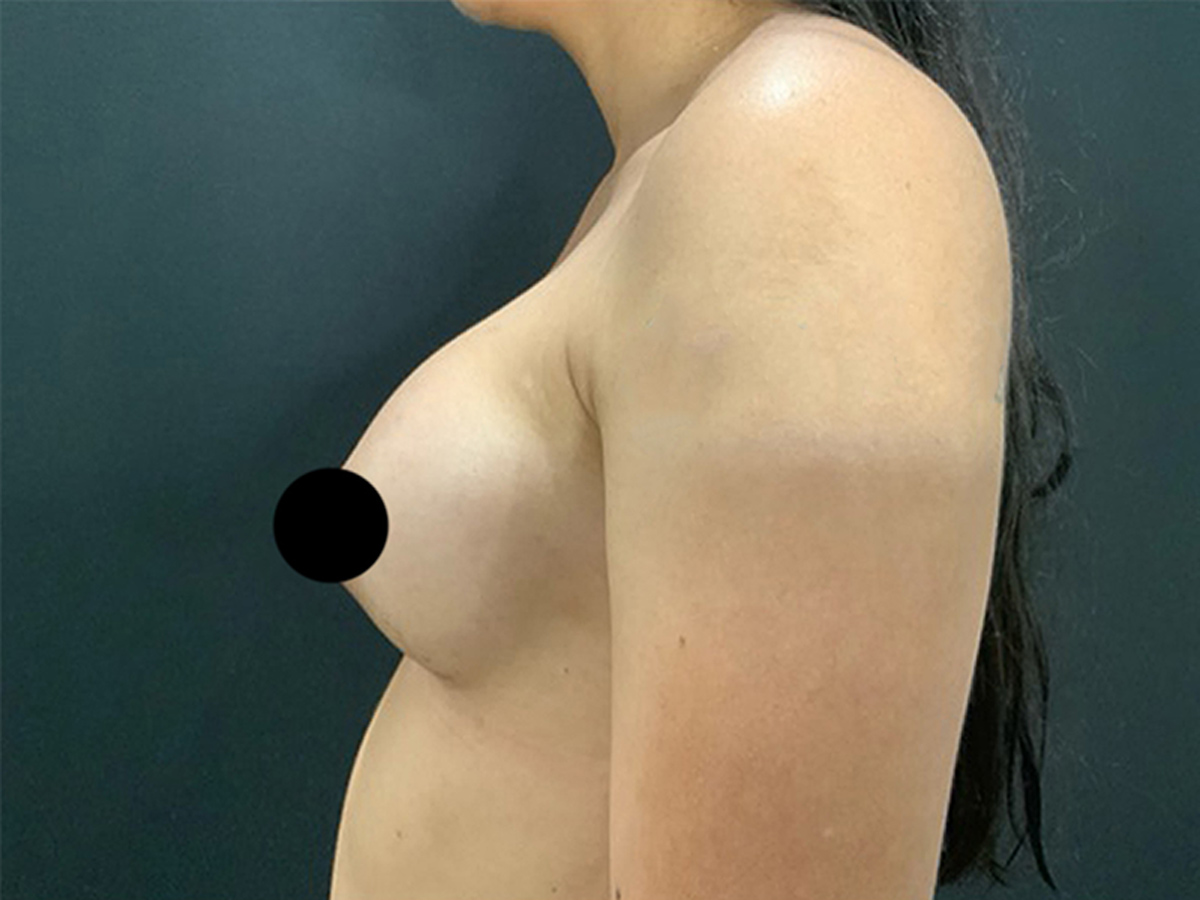 Breast Augmentation