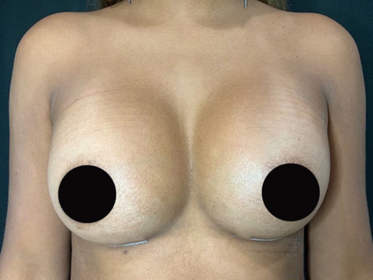 Case--4600 | After Breast Augmentation