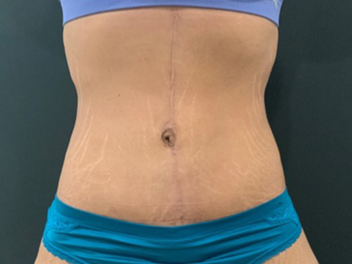 Case--3609 | After Body