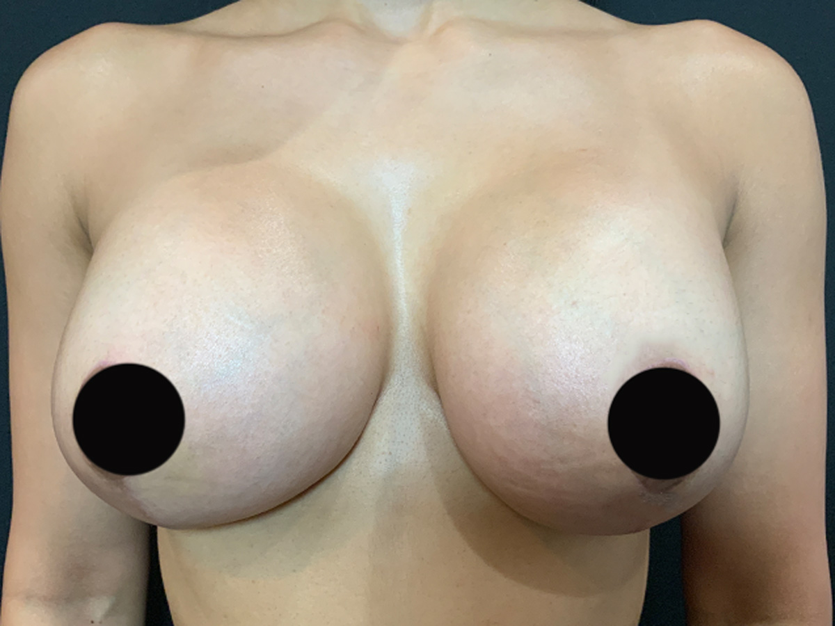 Case--5372 | After Breast