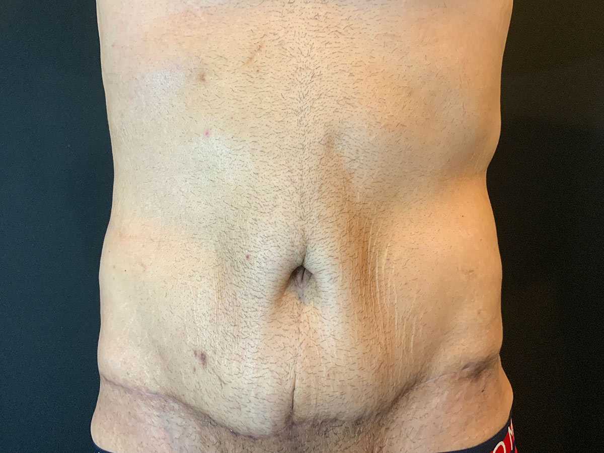 Case--2832 | After Tummy Tuck