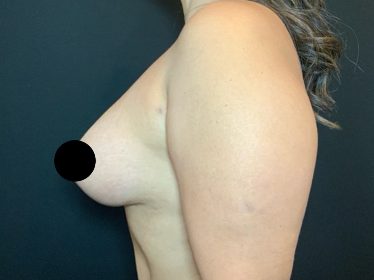 Case--9221 | After Breast Lift 2