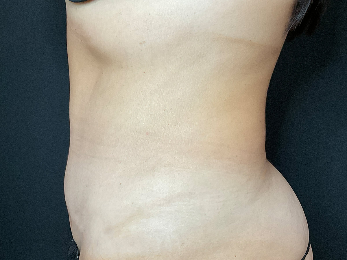 Case--8410 | After Tummy Tuck 2