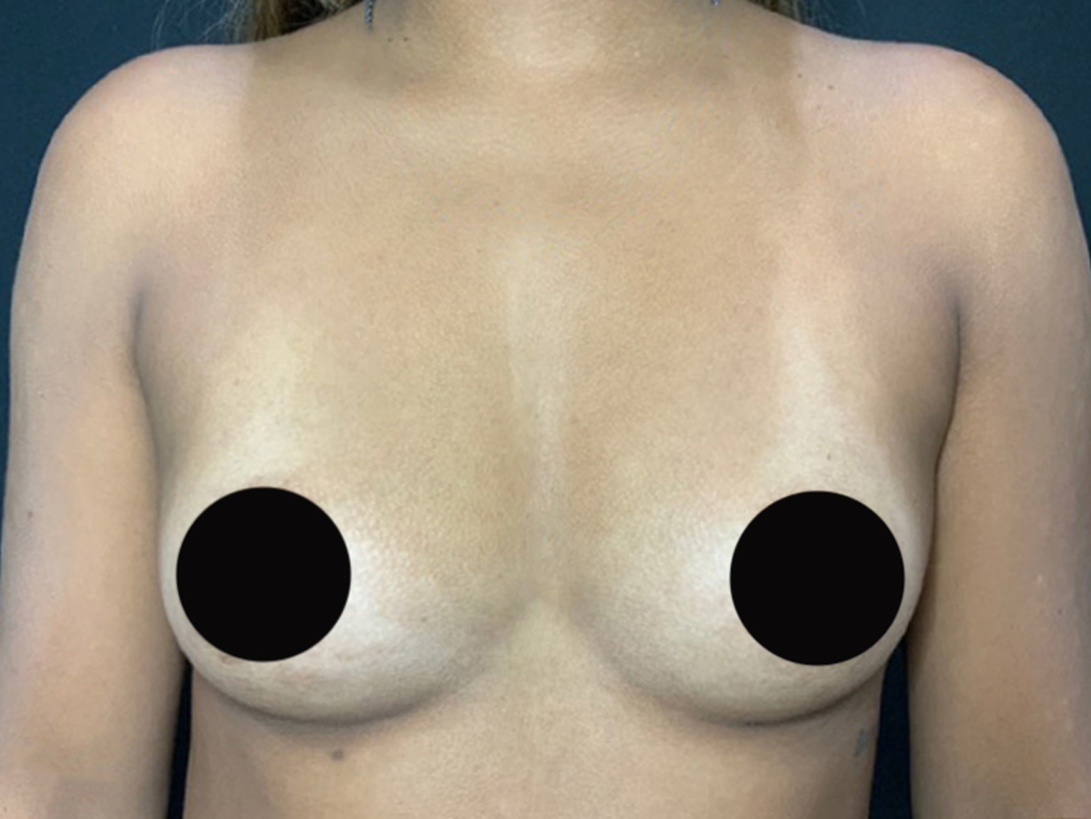 Case--4600 | Before Breast Augmentation