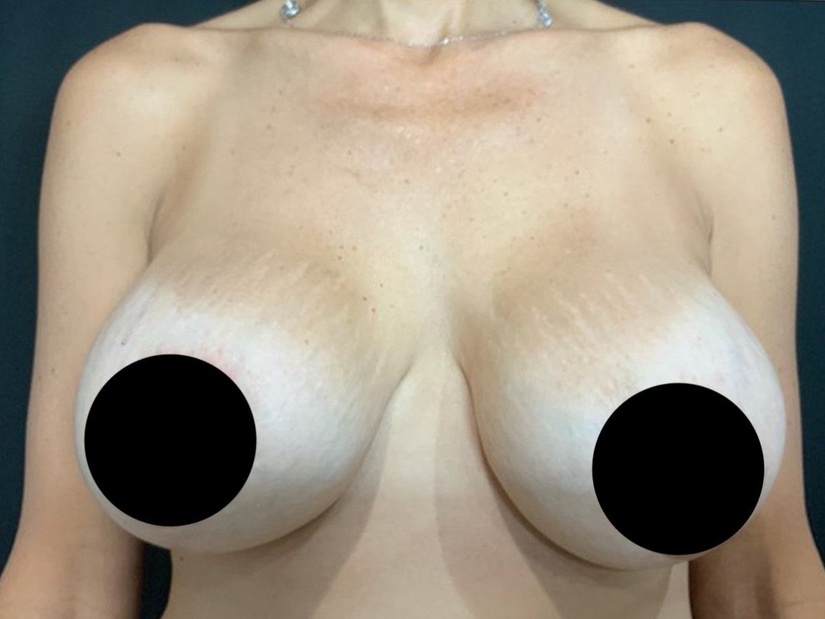 Case--3249 | Before Mommy Makeover