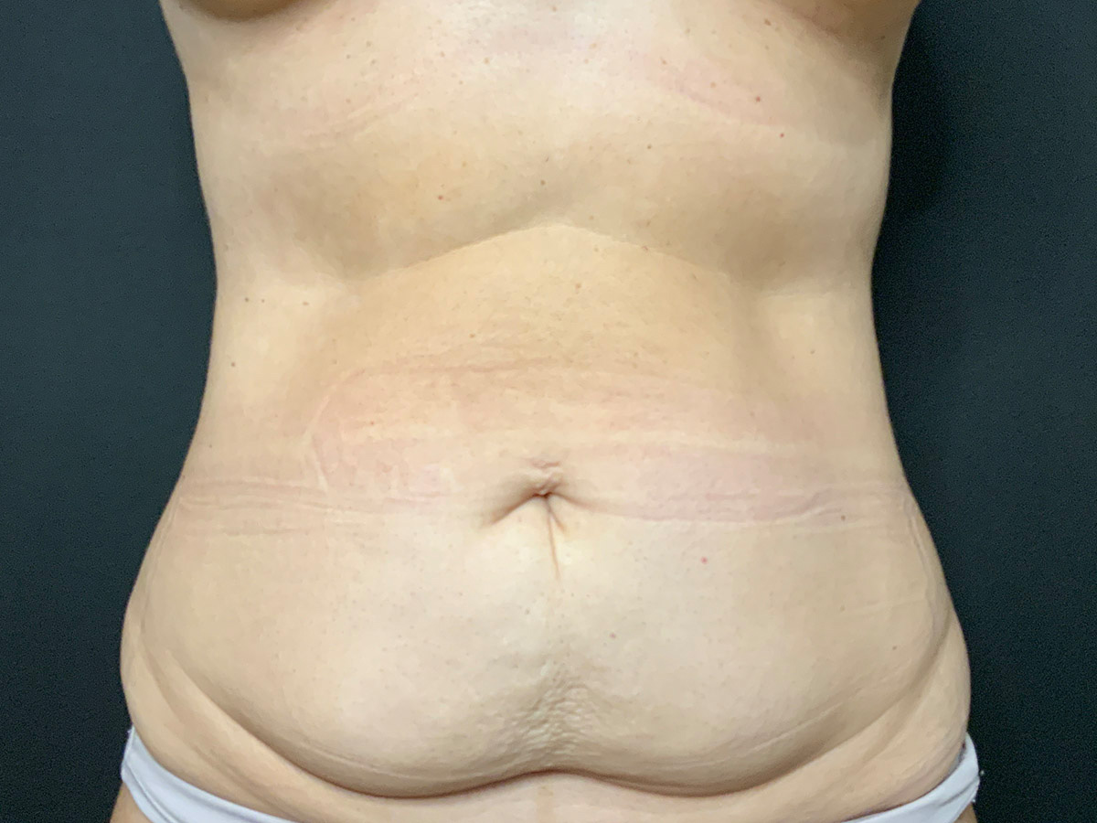 Case--8410 | Before Tummy Tuck