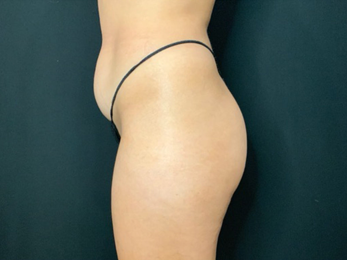 Case--6909 | Before Brazilian Butt Lift 2