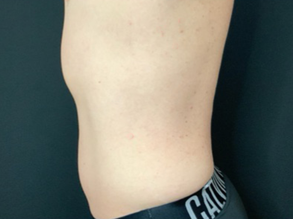 Case--8122 | Before Male Liposuction 3