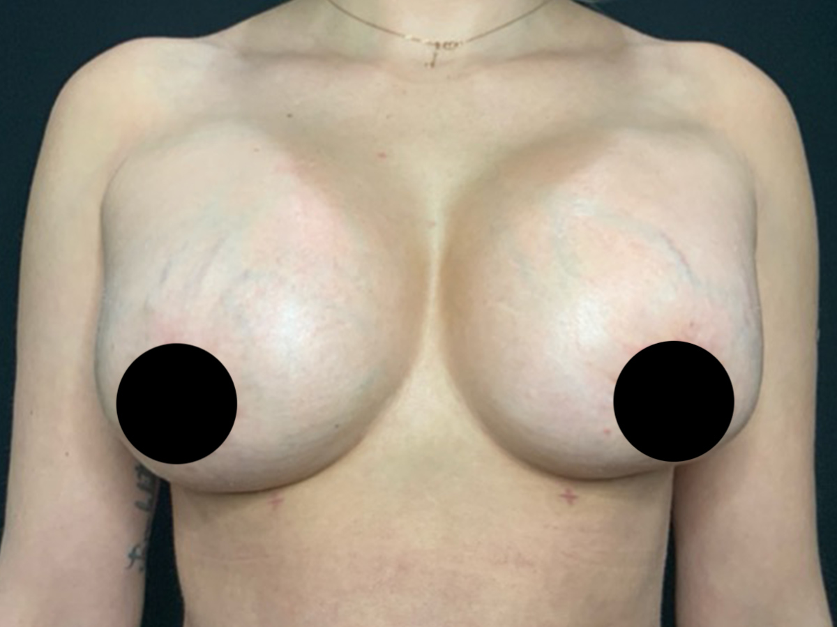 Case--9251 | After Breast