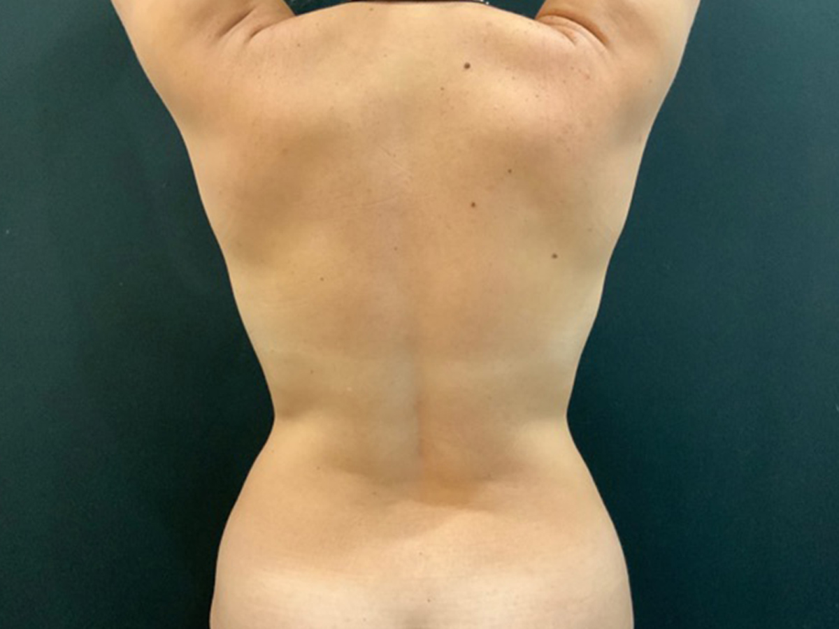 Case--2441 | Before Liposuction 2