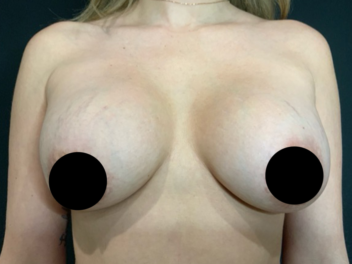 Case--9251 | Before Breast