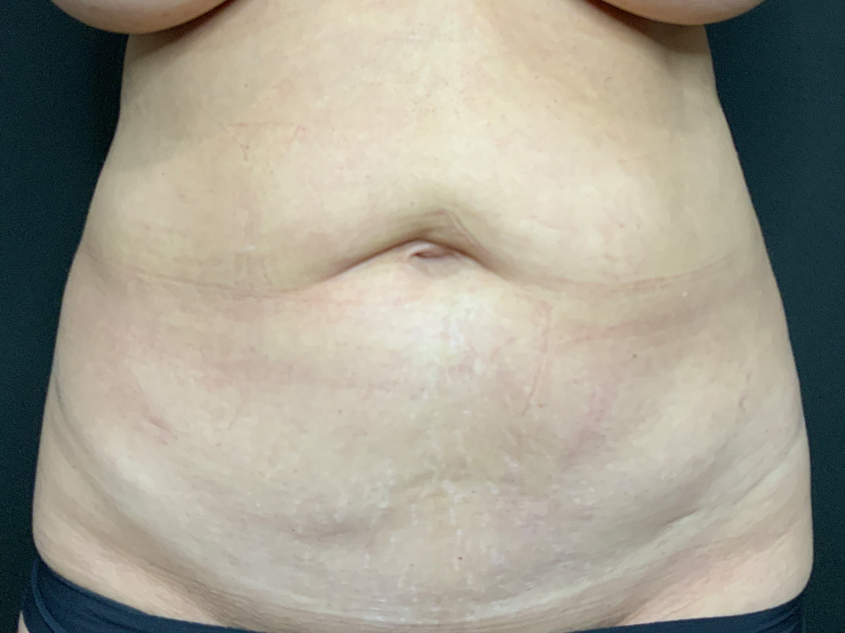 Case--9899 | Before Tummy Tuck