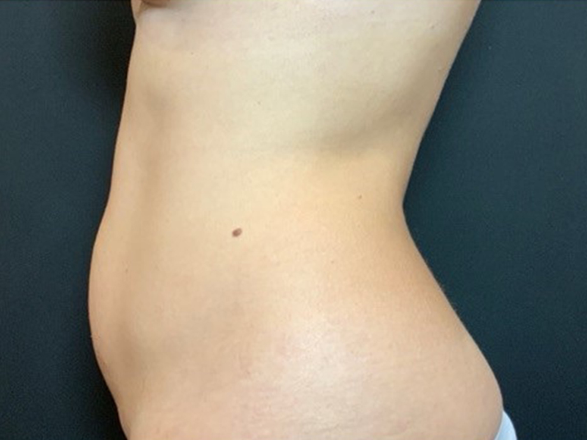 Case--2441 | Before Liposuction 3