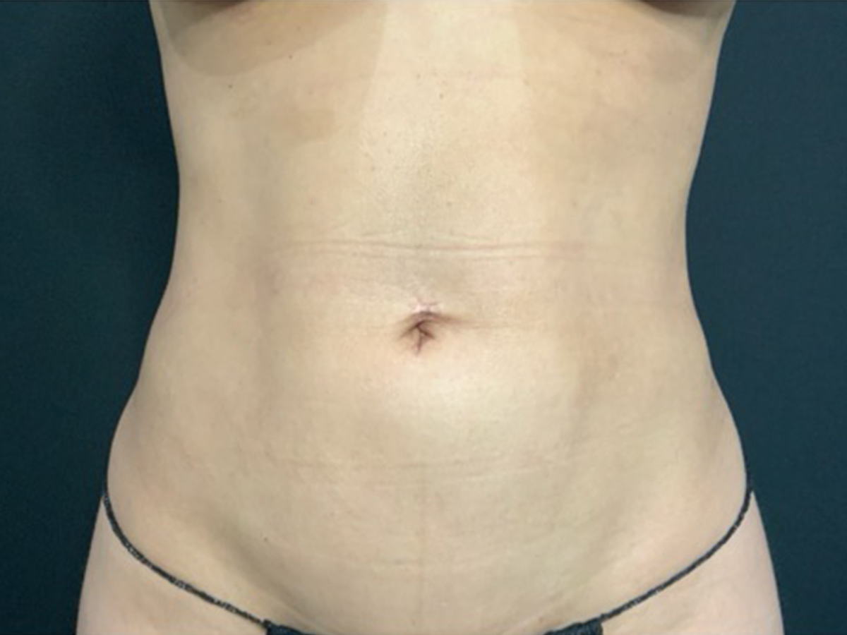 Case--7946 | After Body