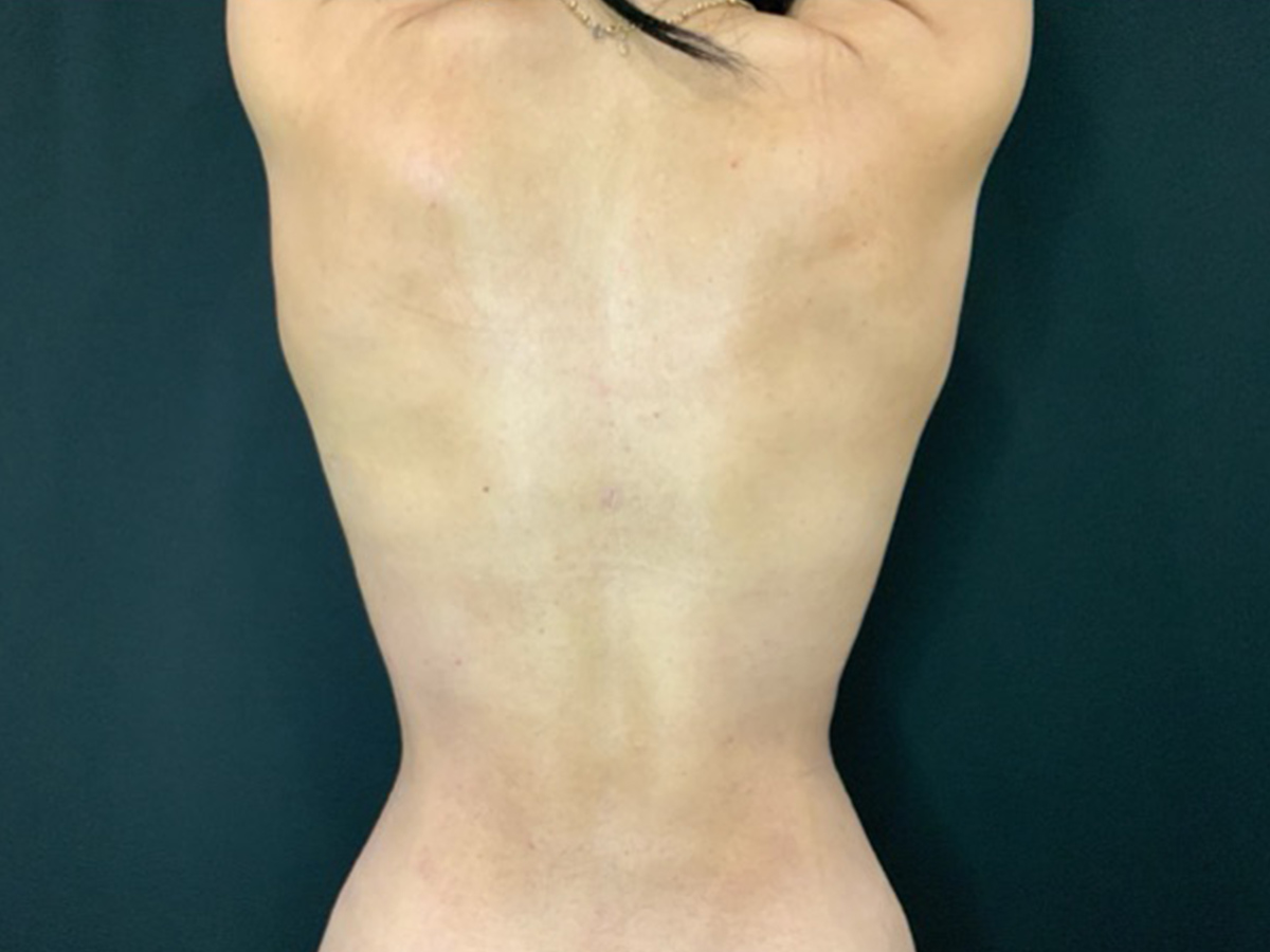 Case--7946 | After Liposuction 2