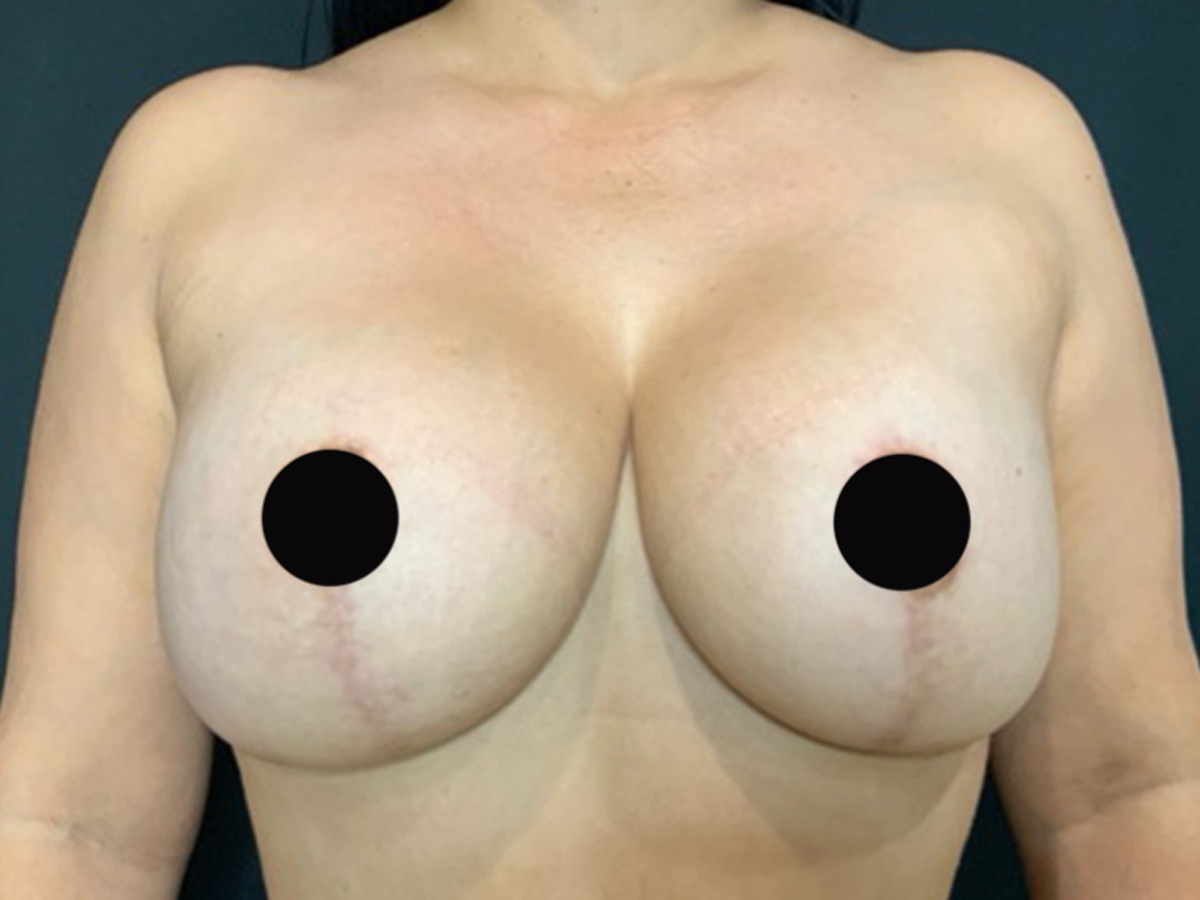 Case--6062 | After Breast