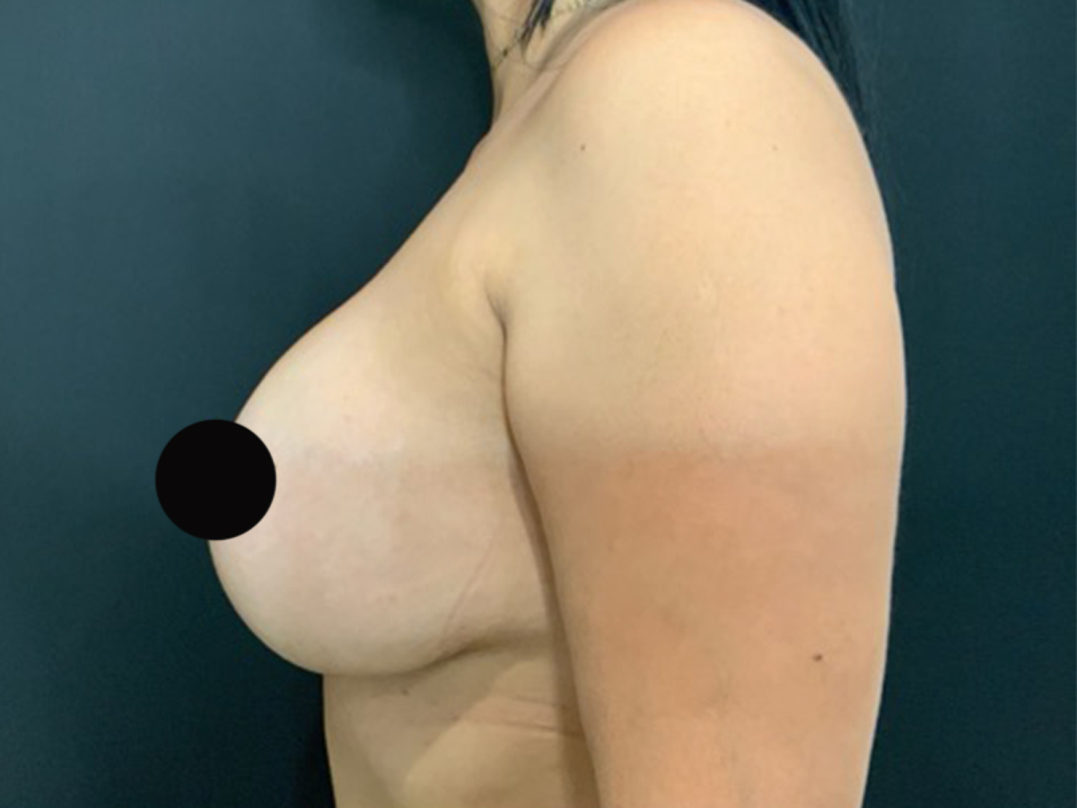 Case--6062 | After Breast Revision 2
