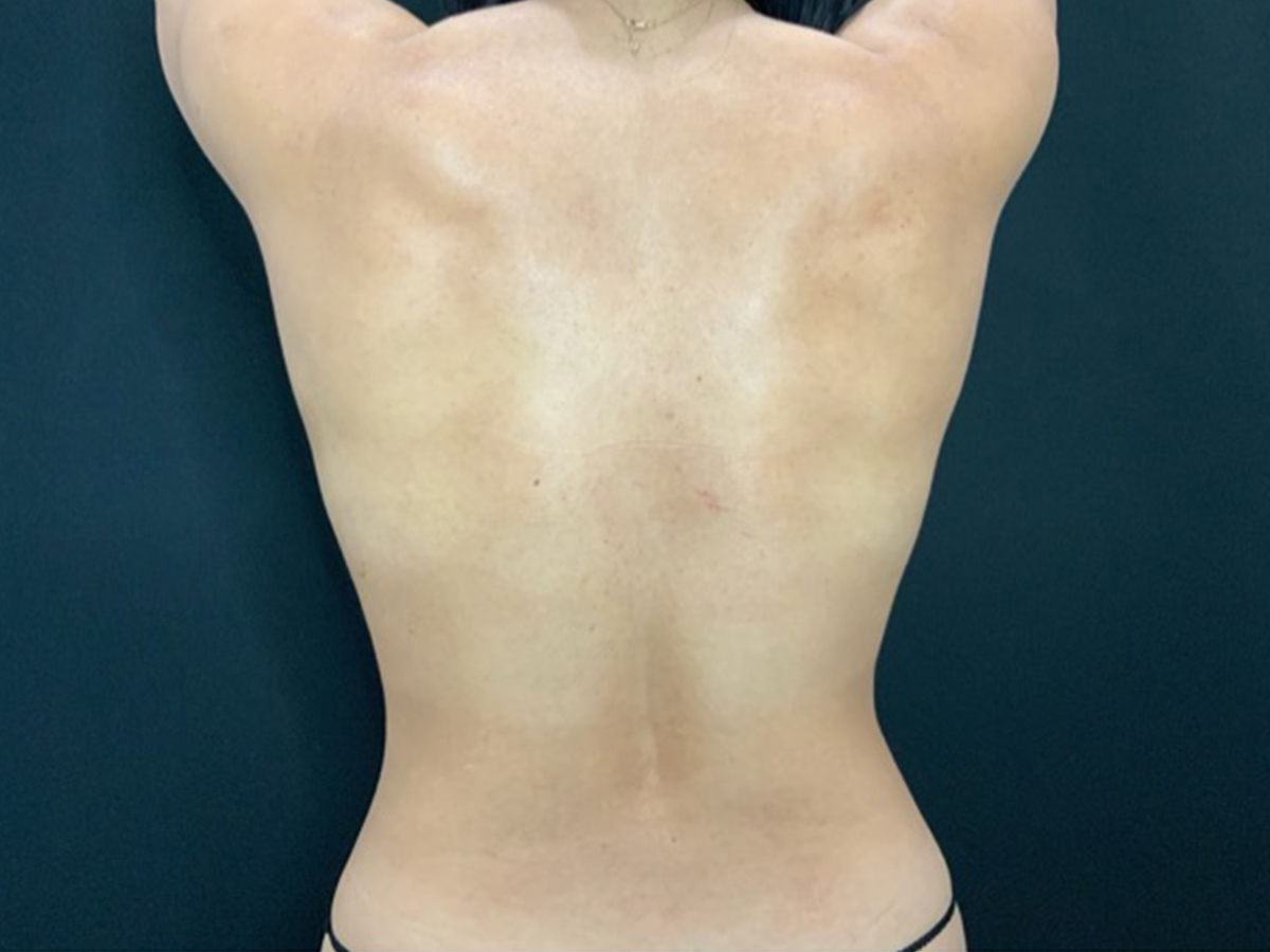 Case--7946 | Before Liposuction 2