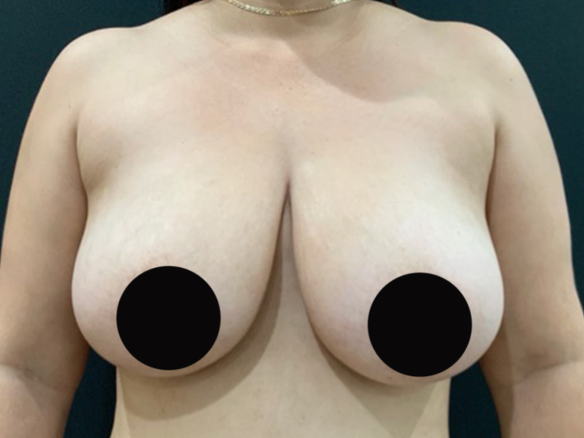 Case--6062 | Before Breast