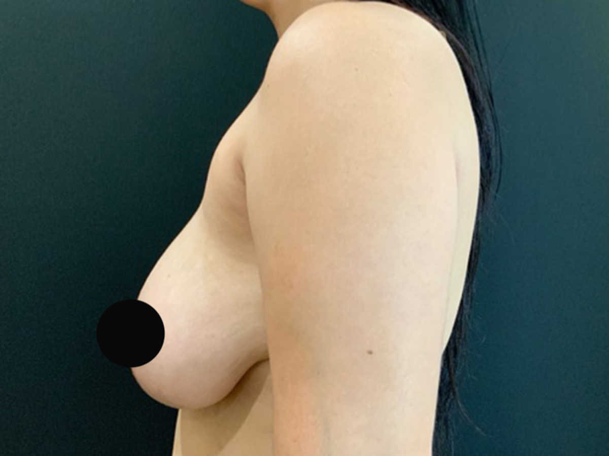 Case--6062 | Before Breast Revision 2