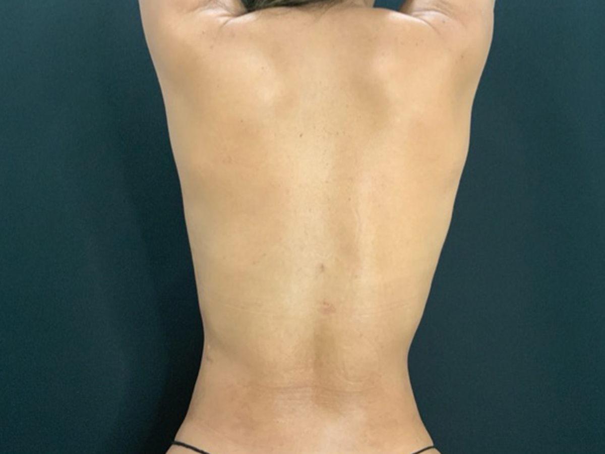 Case--6995 | After Liposuction 2