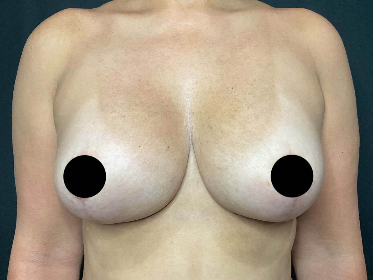 Case--8770 | After Breast