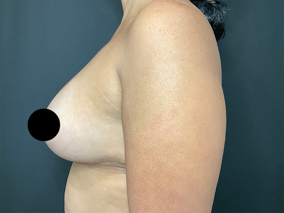 Case--8770 | After Breast Revision 2