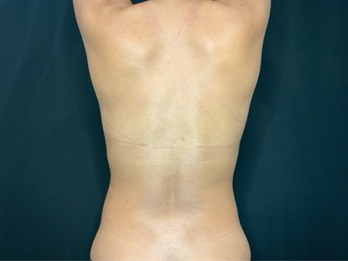 Case--6995 | Before Liposuction 2
