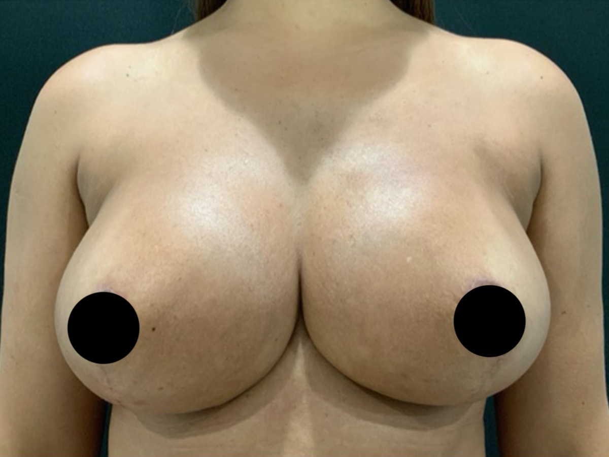 Case--1571 | After Breast