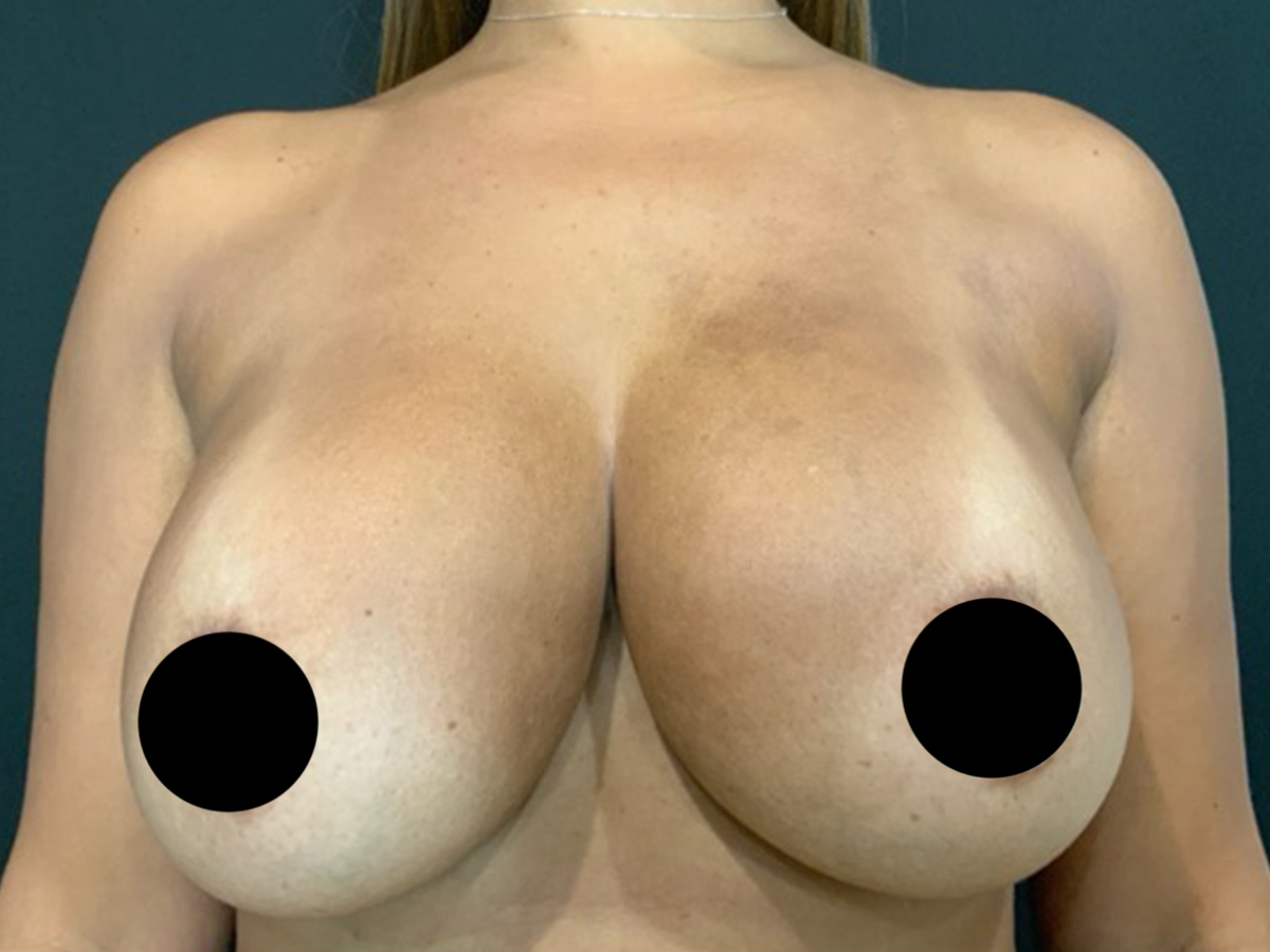 Case--1571 | Before Breast