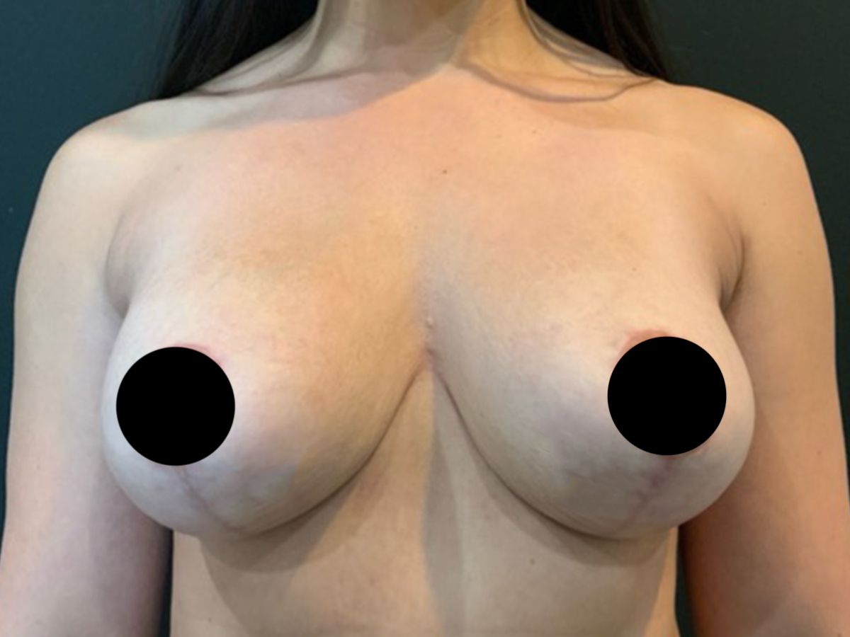 Case--2309 | After Breast