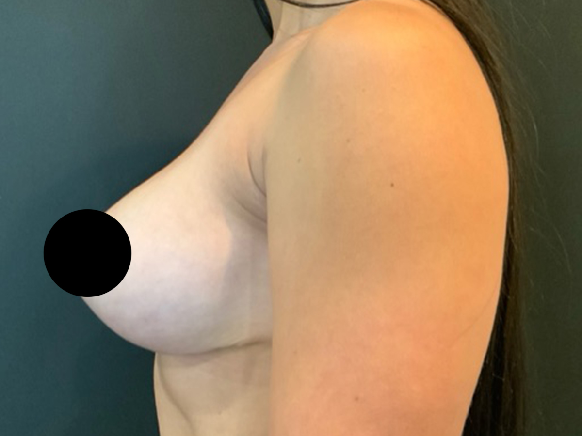 Case--2309 | After Breast Revision 2