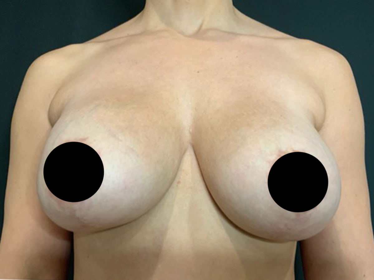 Case--2309 | Before Breast