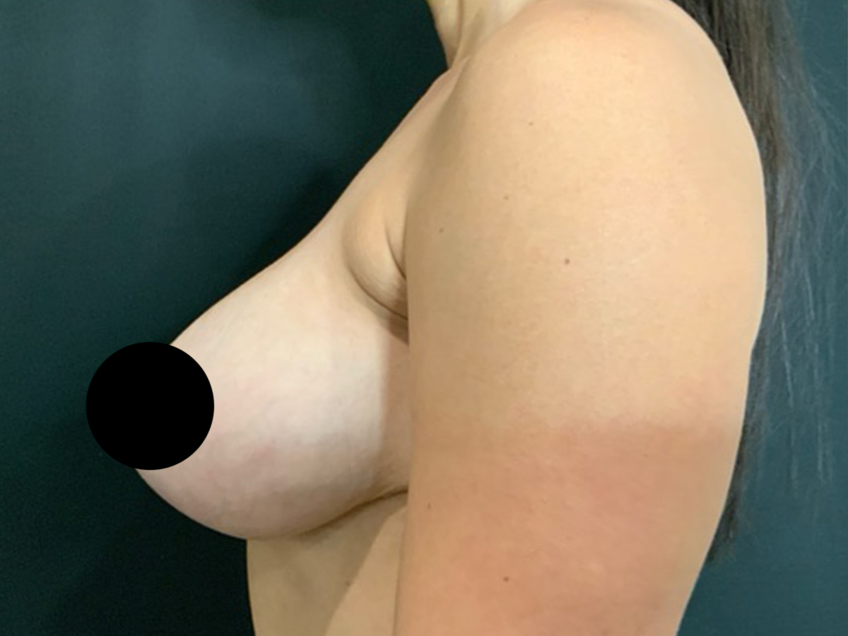 Case--2309 | Before Breast Revision 2