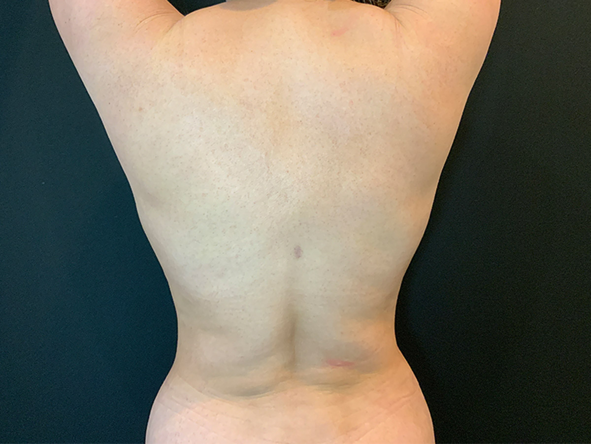 Case--3881 | After Liposuction 2