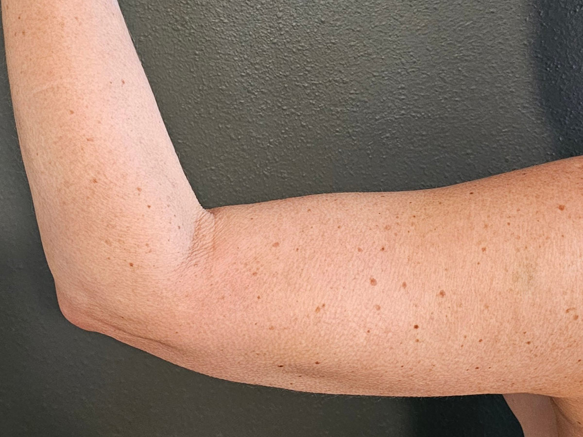 Case--3008 | After Body