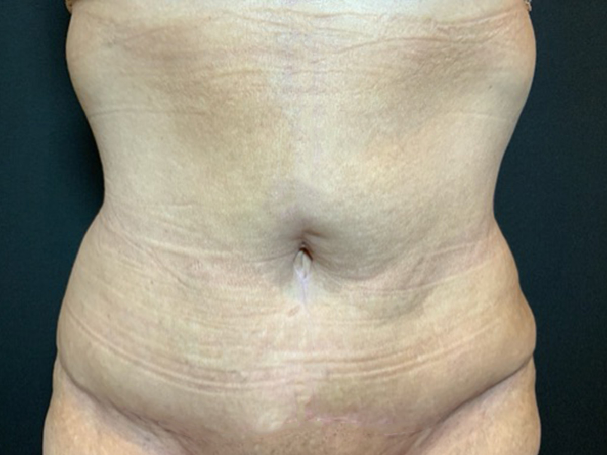 Case--2683 | After Body