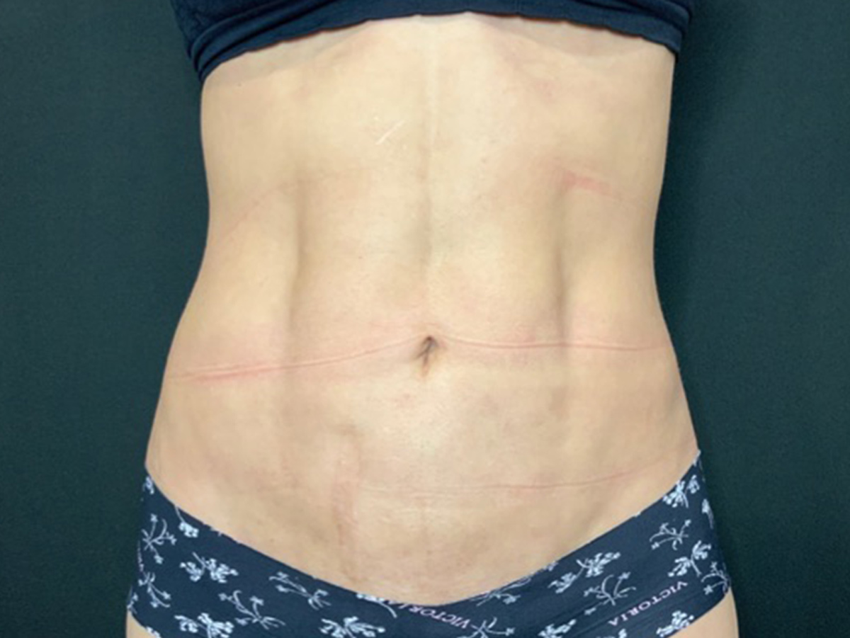 Case--1510 | After Body