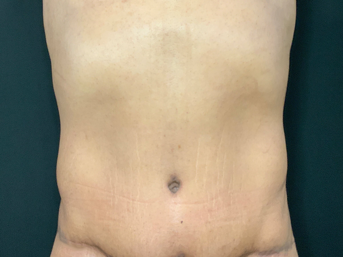 Case--4828 | After Tummy Tuck