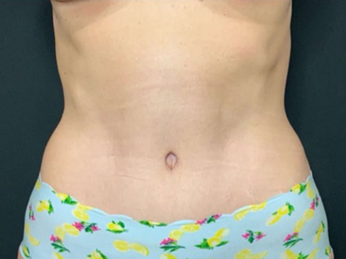 Case--7011 | After Tummy Tuck