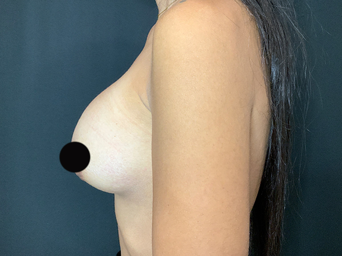 Case--2758 | After Breast Augmentation 2